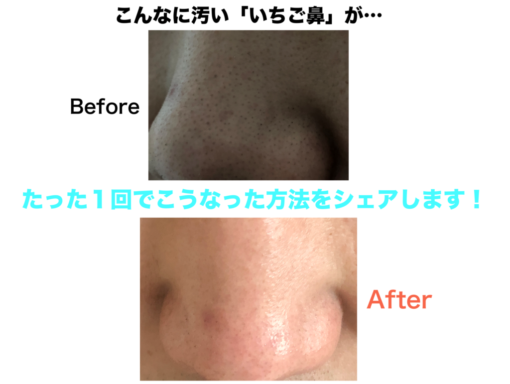 男 いちご鼻